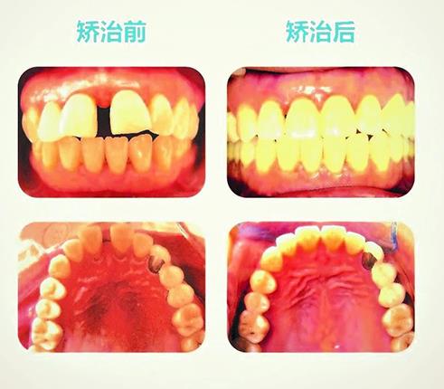 种牙之牙齿损坏篇