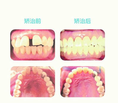 补牙中常见材料具体特征的简单介绍